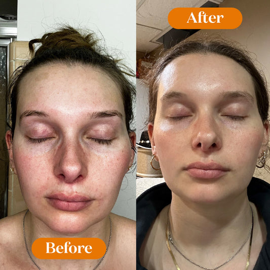 Before and after comparison of a woman's face with 'Before' on the left and 'After' on the right.