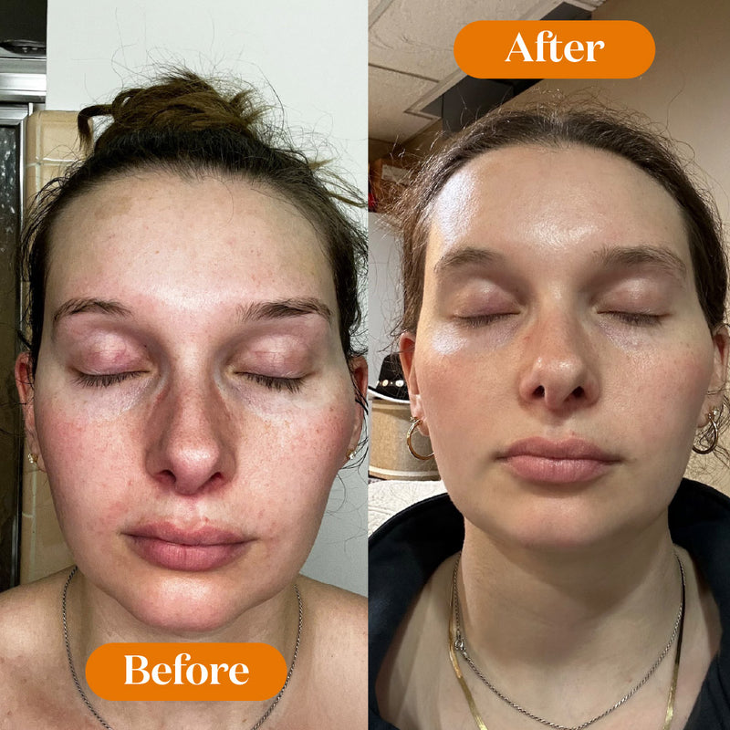 Before and after comparison of a woman's face with 'Before' on the left and 'After' on the right.