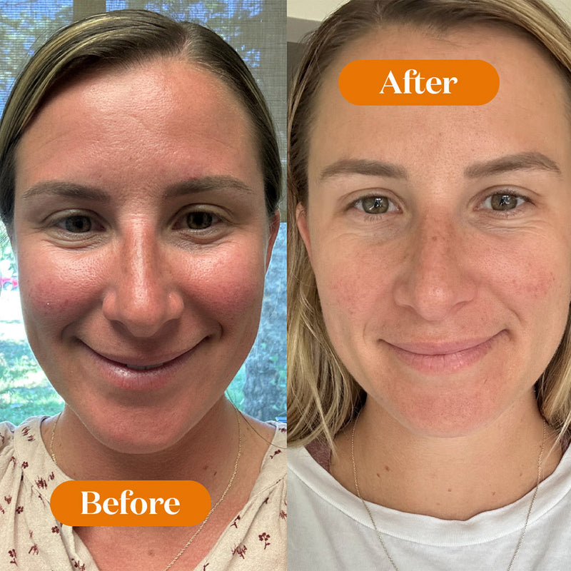 Before and after comparison of a woman's face with 'Before' on the left and 'After' on the right.