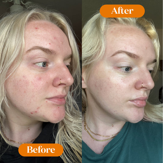 Before and after comparison of a person with acne on their face.